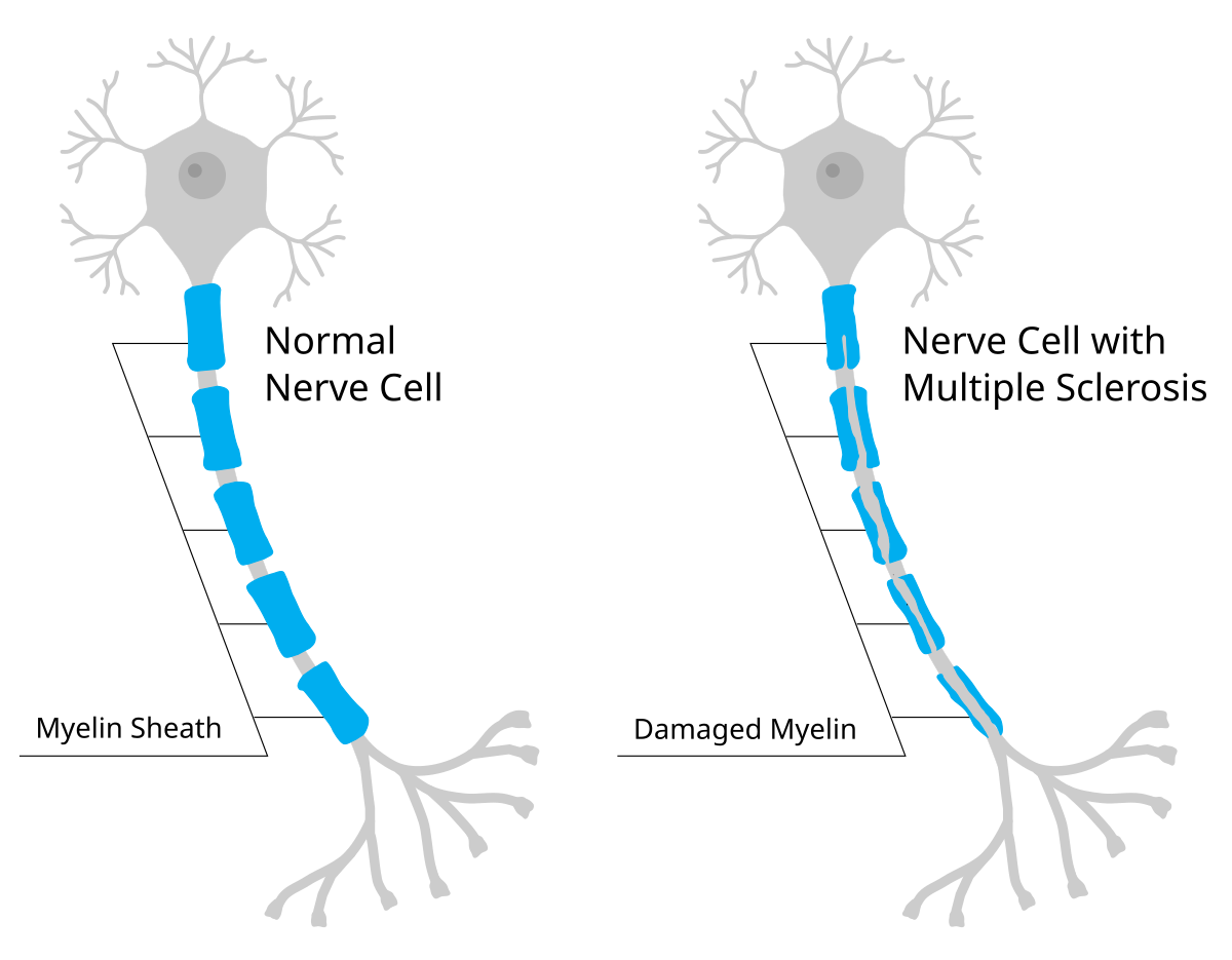 Comparação entre um neurónio saudável (com bainha de mielina intacta) e um neurónio com mielina danificada na Esclerose Múltipla